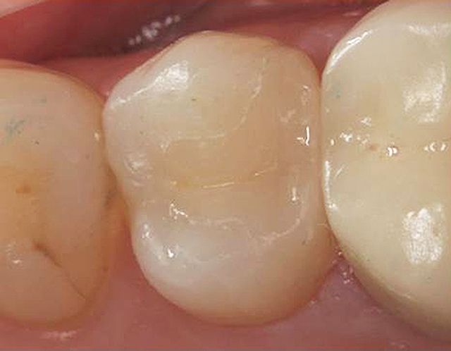 Tooth with ceramic filling