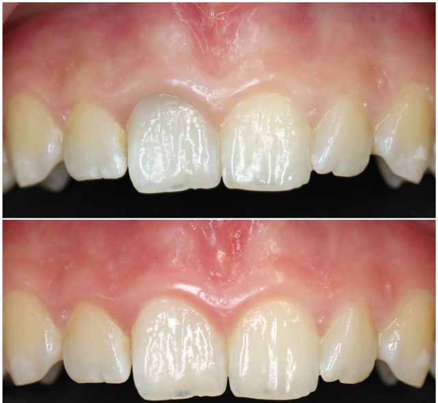 A before (top)  and after (bottom) view of an endobleaching treatment.