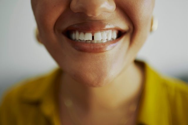 Some patients find a visible gap between their teeth (diastema) disturbing