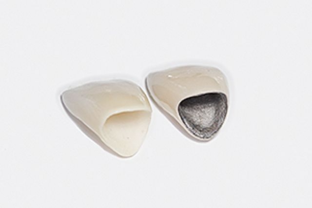 Comparison of the all-ceramic crown (left) and the metal-ceramic crown (right)