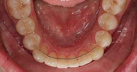 Engstand Behandlung mit unsichtbarer Zahnspange