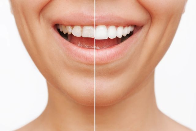 Veneers Before After Example Image