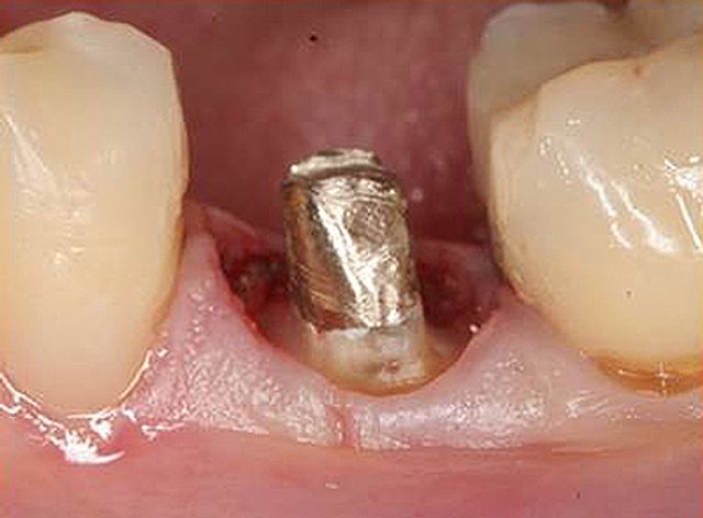 Tooth with inserted pin